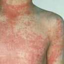 After 12 to 48 hours the characteristic fine red rash of scarlet fever develops