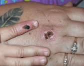 Monkeypox is a rare disease caused by infection with the monkeypox virus (Photo: CDC/Getty Images)