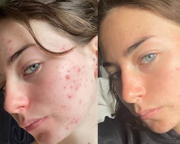 Fight breakouts with 47 Skin and the revolutionary skincare ingredient you’ve properly never heard of 