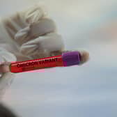 Confirmed cases of omicron have shown a significant spike in Fife