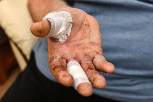 Alistair Neilson's injured hand