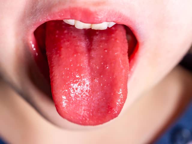 Tongue of a child with scarlet fever - strawberry tongue.