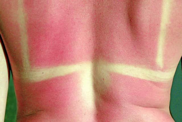 Sunburn is painful, unsightly - and can also cause serious long term health problems.