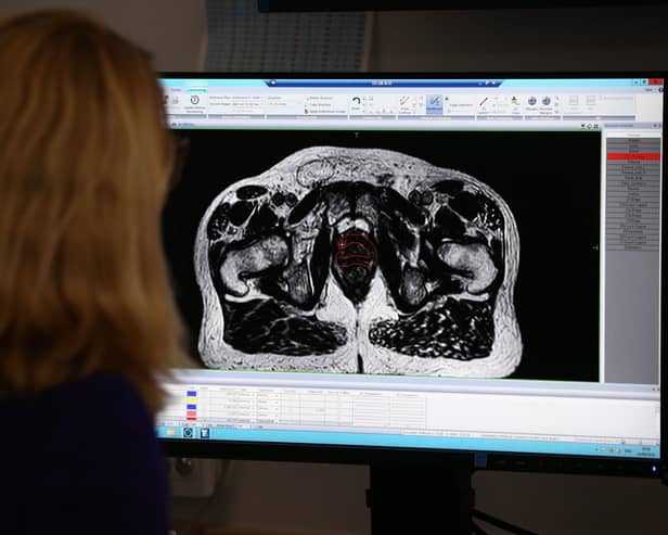 The scan of a patient diagnosed with prostate cancer