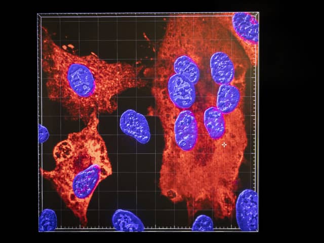 An image created with a confocal microscope shows cell nuclei (blue) being infected by SARS-CoV-2 (red areas), the virus which causes COVID-19,