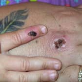 The monkeypox virus shown on a patient's hand