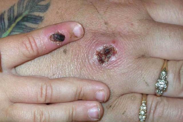The monkeypox virus shown on a patient's hand