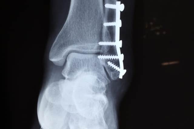 Xray of broken ankle
