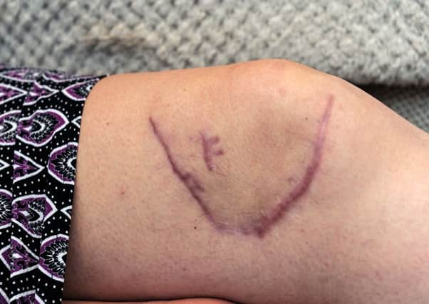 Julie's wound needed 30 stitches. Picture: Michael Gillen