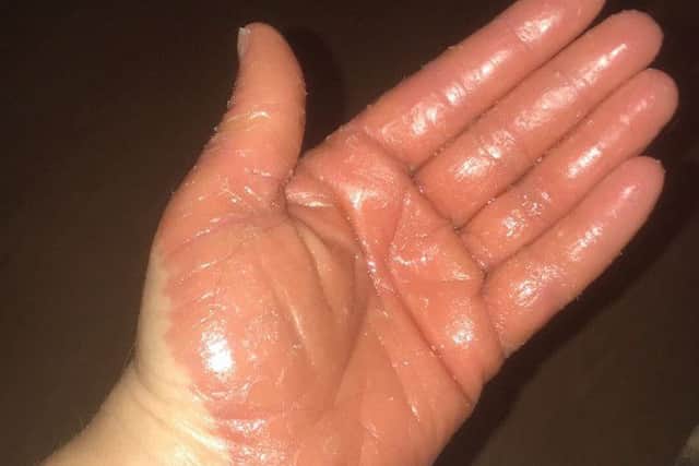 Carolann Monteith's hands peeled due to rare skin condition Pityriasis Rubra Pilaris
