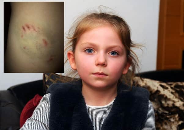 Orla Thomson (7) was bitten by a German Shepherd called Apollo owned by police officer Chris Smith
